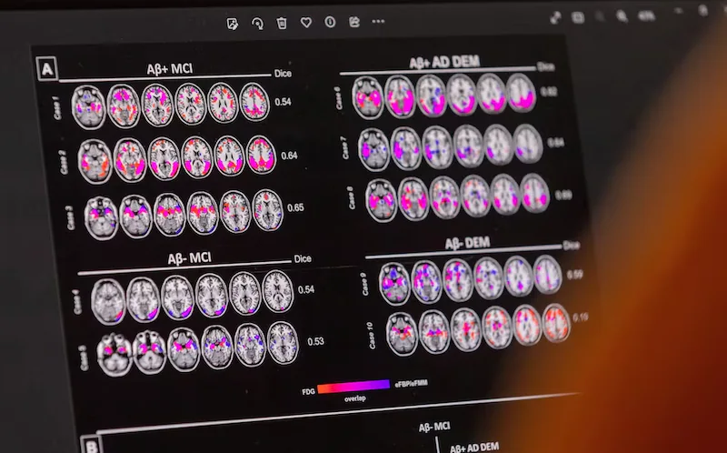 New Study Identifies Double APOE4 Gene Carriers as Prone to Early-Onset Alzheimer's