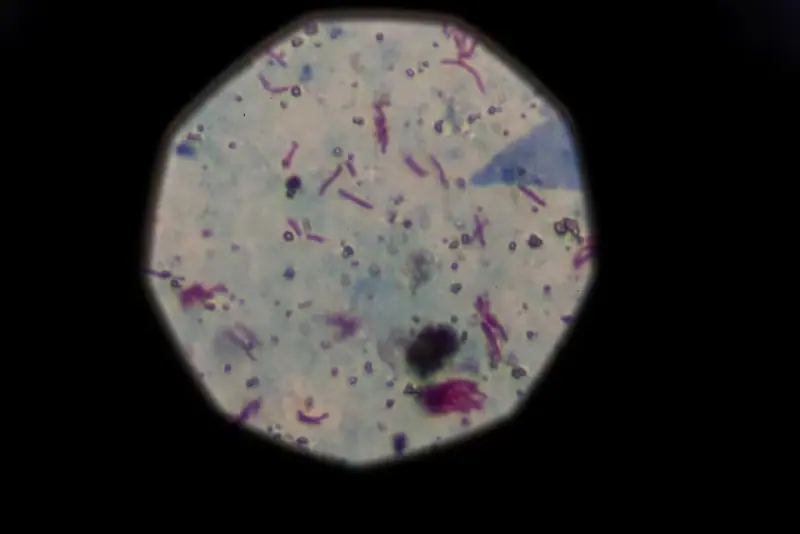 Massive Tuberculosis Outbreak Surfaces in Kansas City Area, Prompting Statewide Response